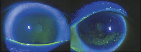 tear film assessment test|precorneal tear film.